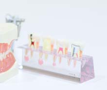 虫歯の進行段階とその治療法